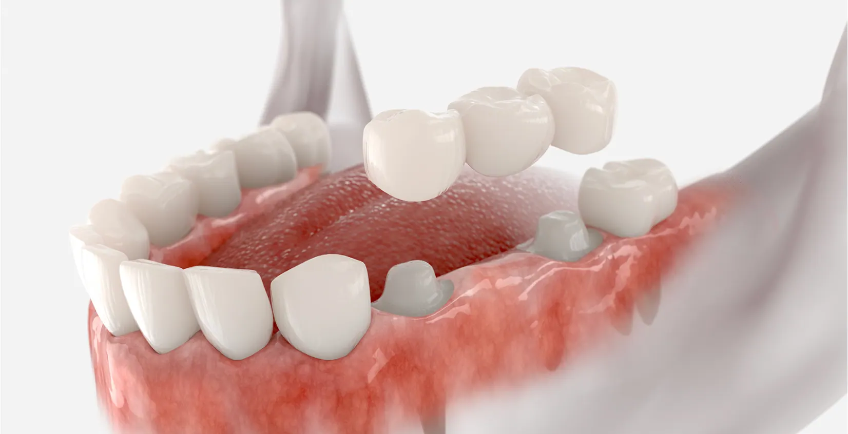 Dental Bridges & Wisdom Teeth