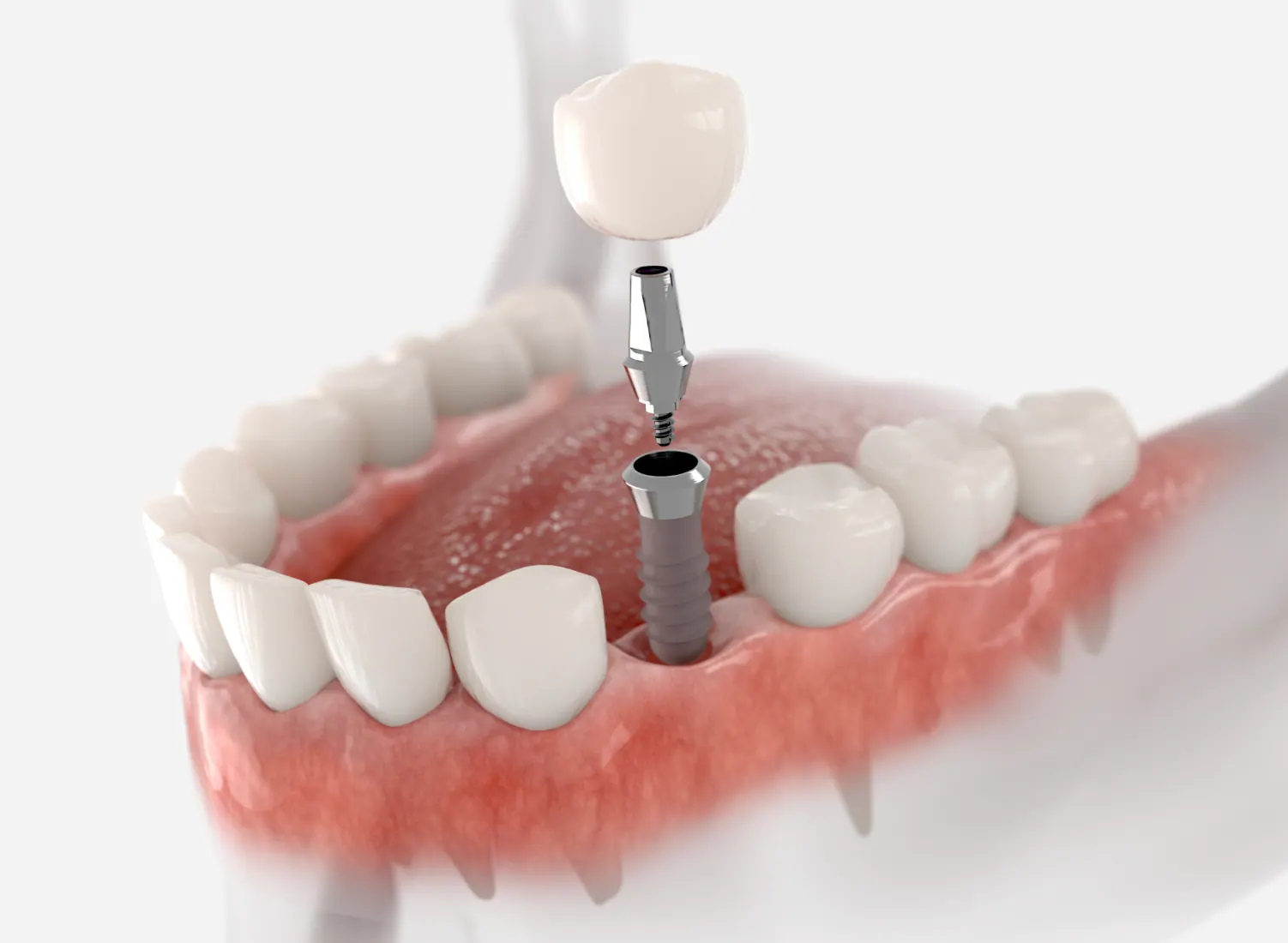 Dental Implants