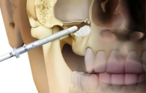 Sinus Lift